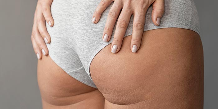 Celulitis persistente